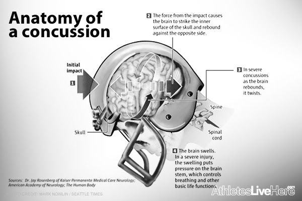 Explanation of a concussion